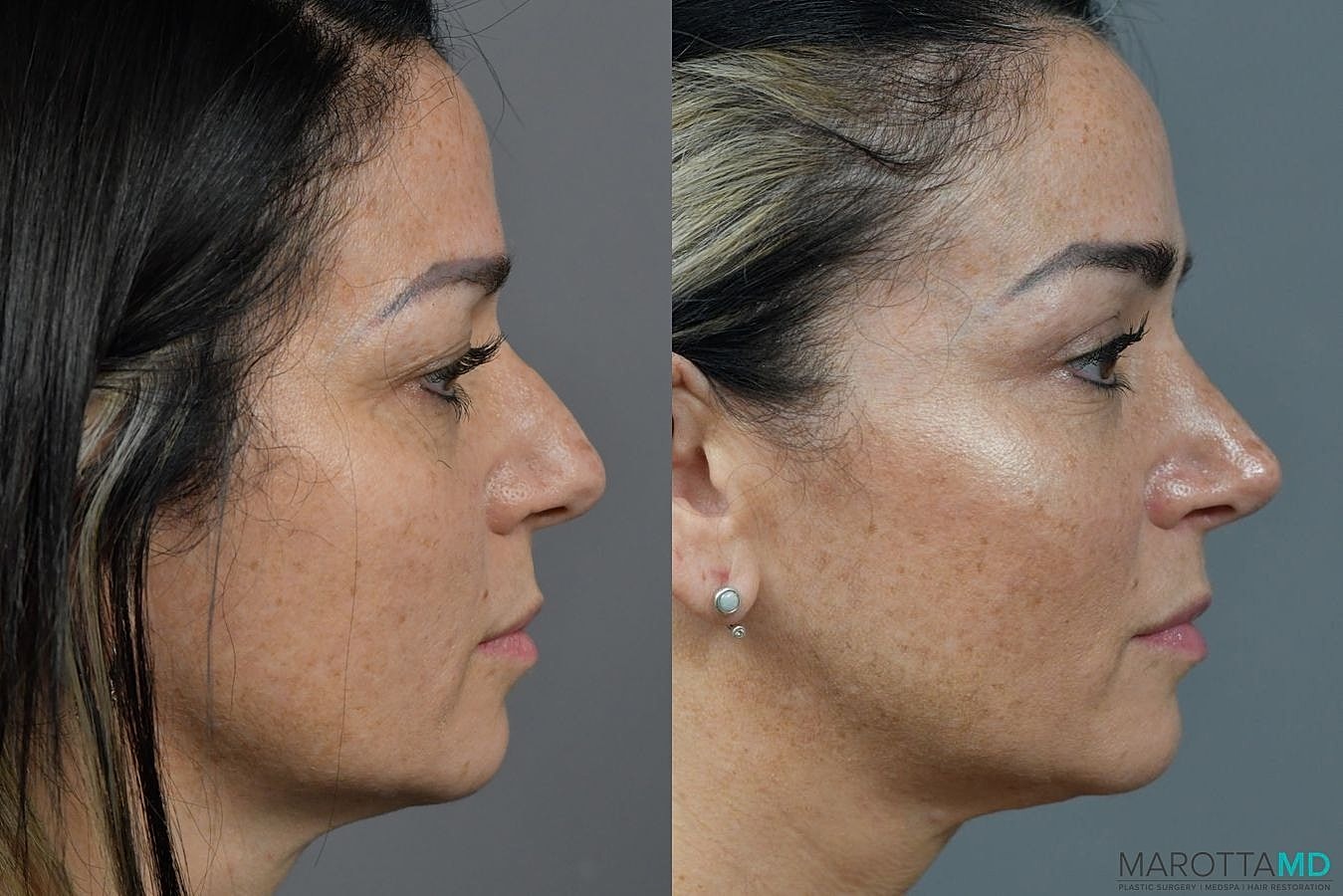 Nose Surgery Before & After