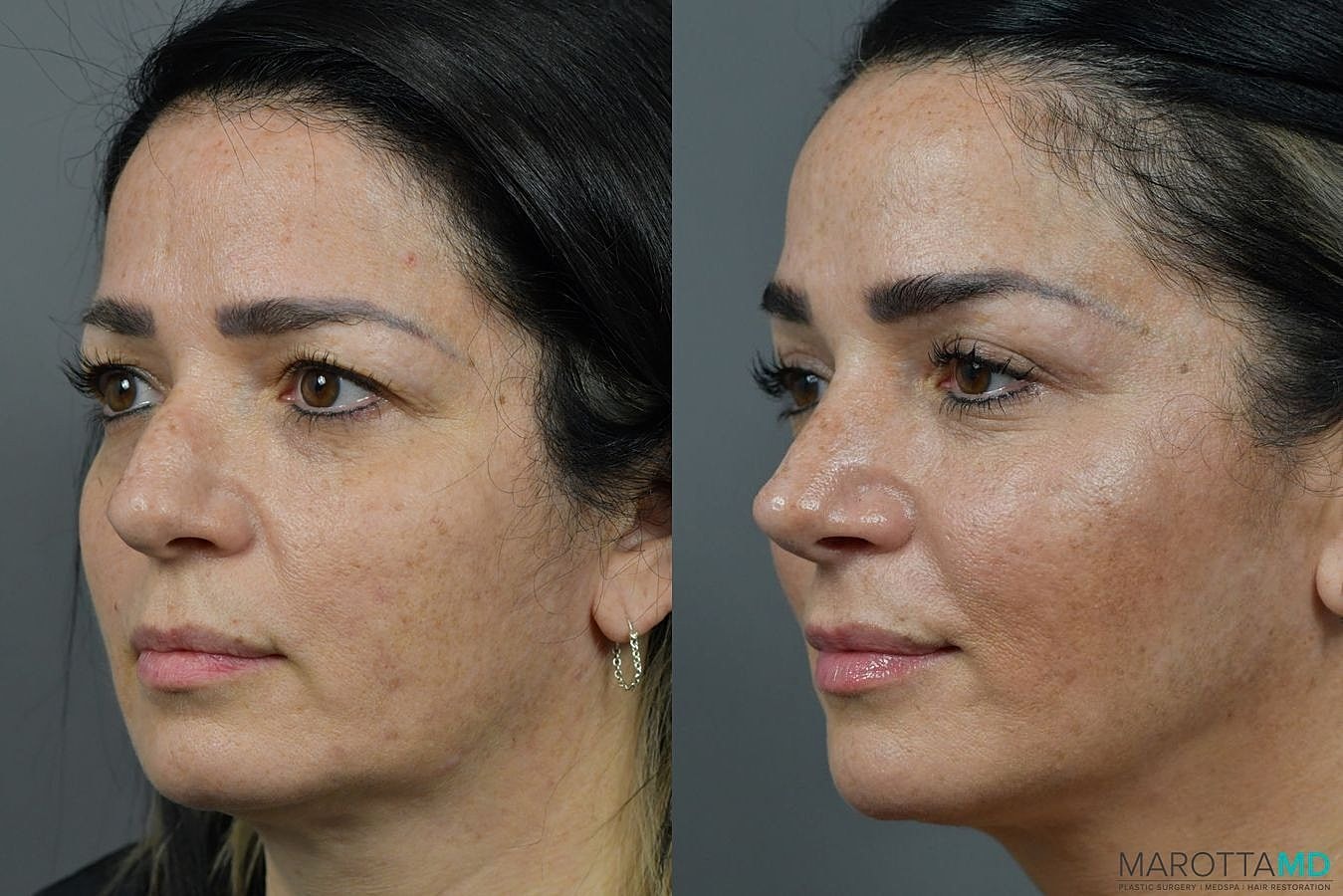 Nose Surgery Before & After