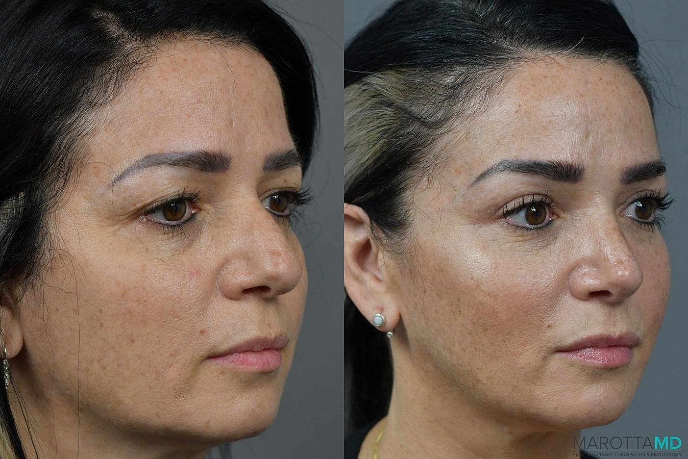 Nose Surgery Before & After