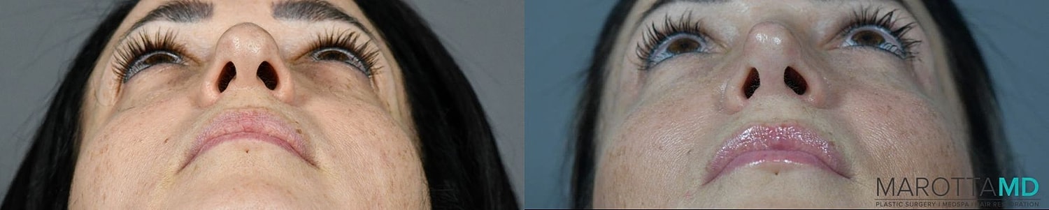Nose Surgery Before & After