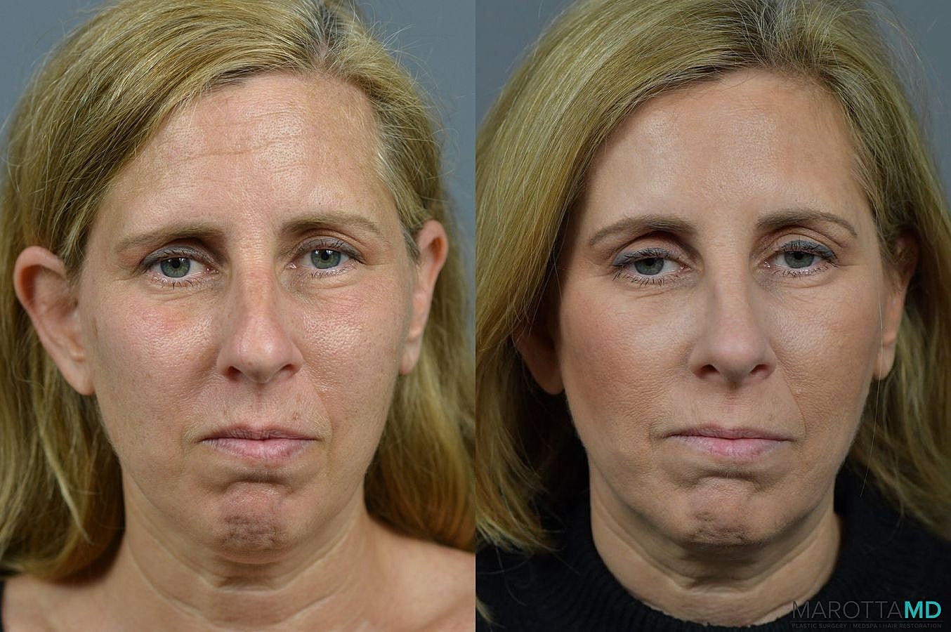 Nose Surgery Before & After