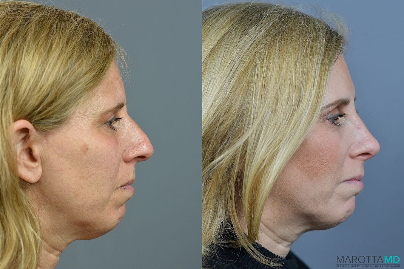 Nose Surgery Before & After