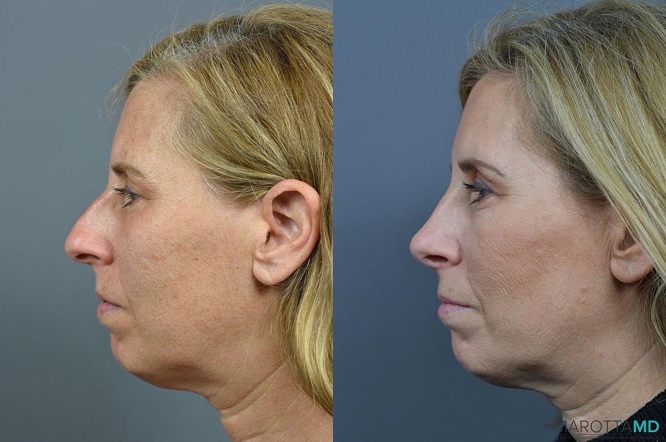 Nose Surgery Before & After
