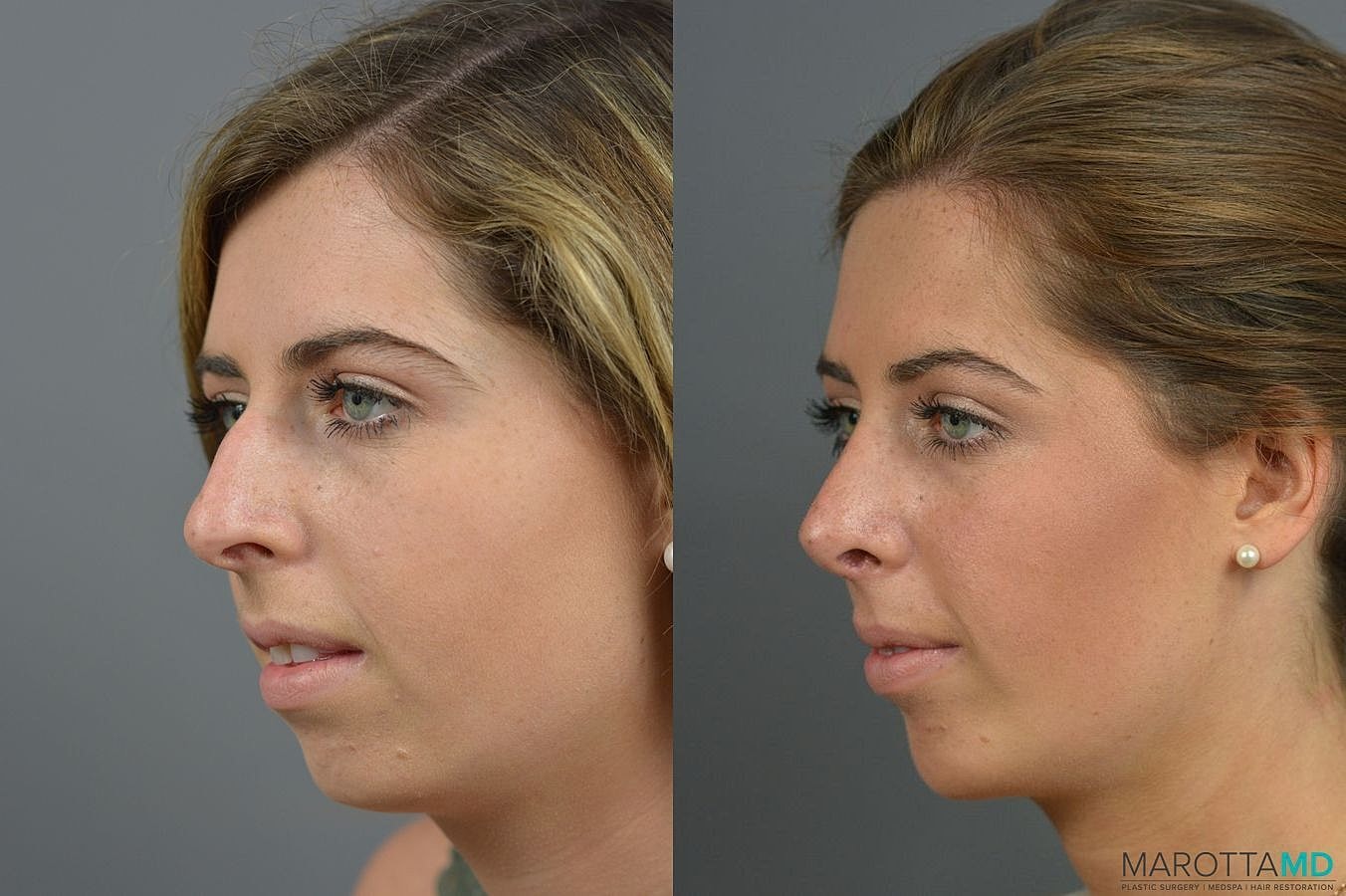 Nose Surgery Before & After