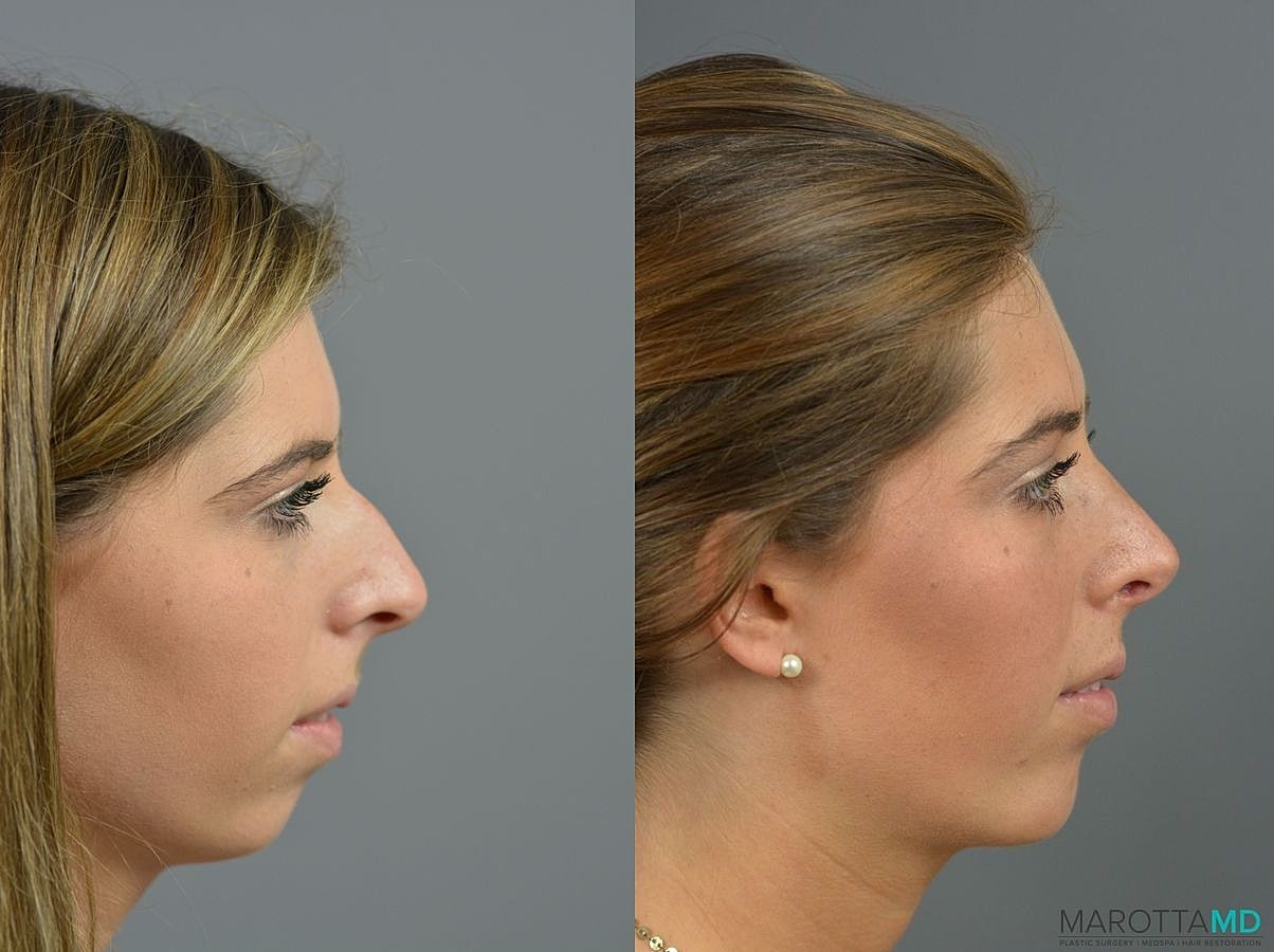 Nose Surgery Before & After