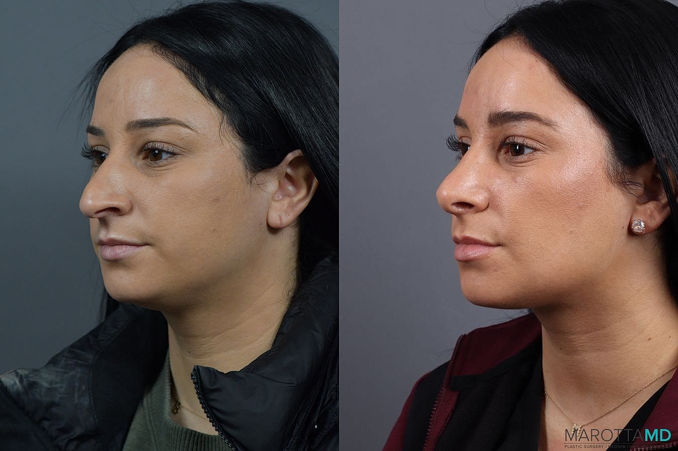 Nose Surgery Before & After