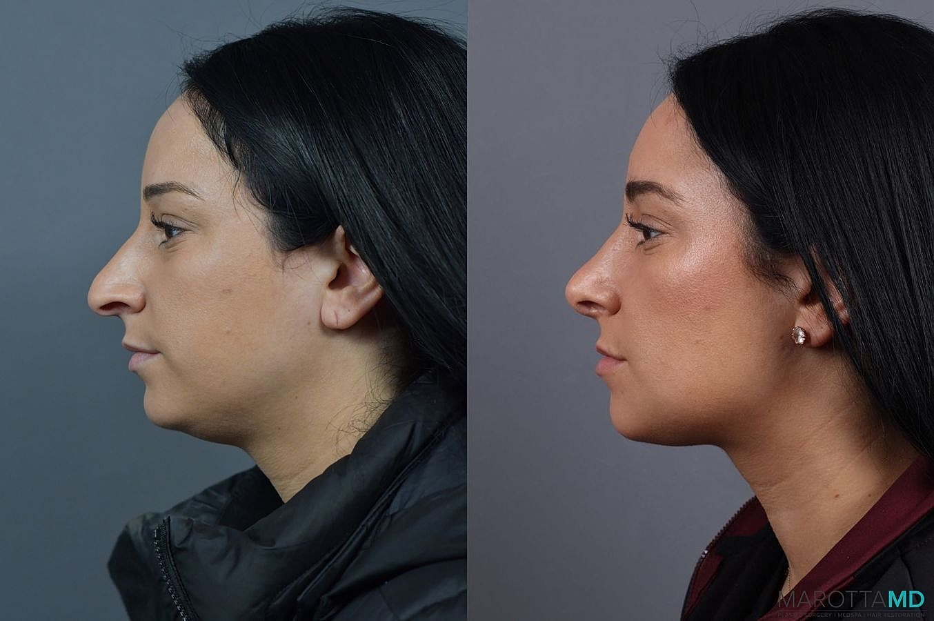 Nose Surgery Before & After