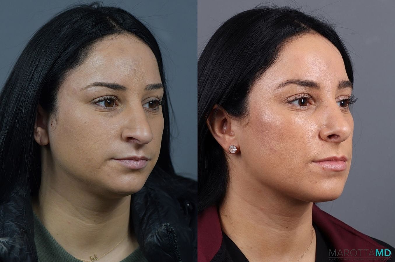Nose Surgery Before & After