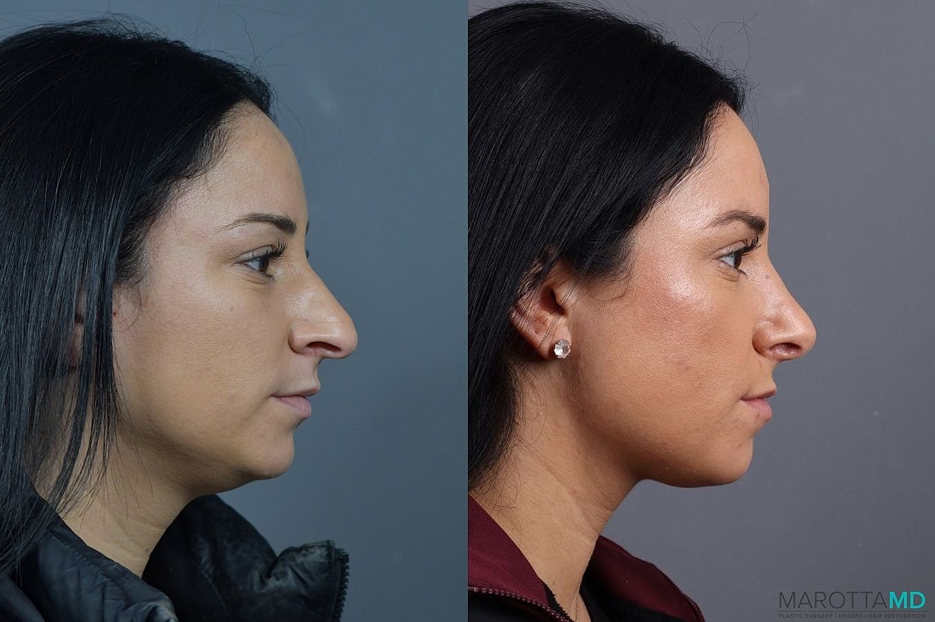Nose Surgery Before & After