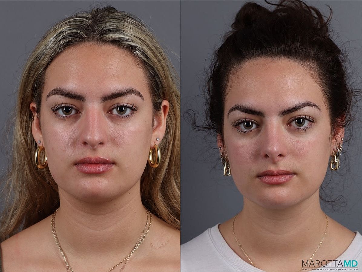Nose Surgery Before & After