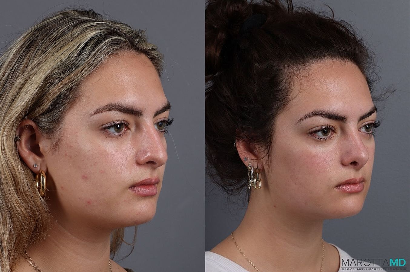 Nose Surgery Before & After