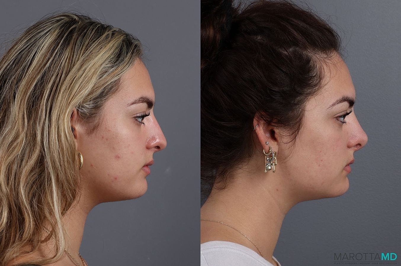 Nose Surgery Before & After