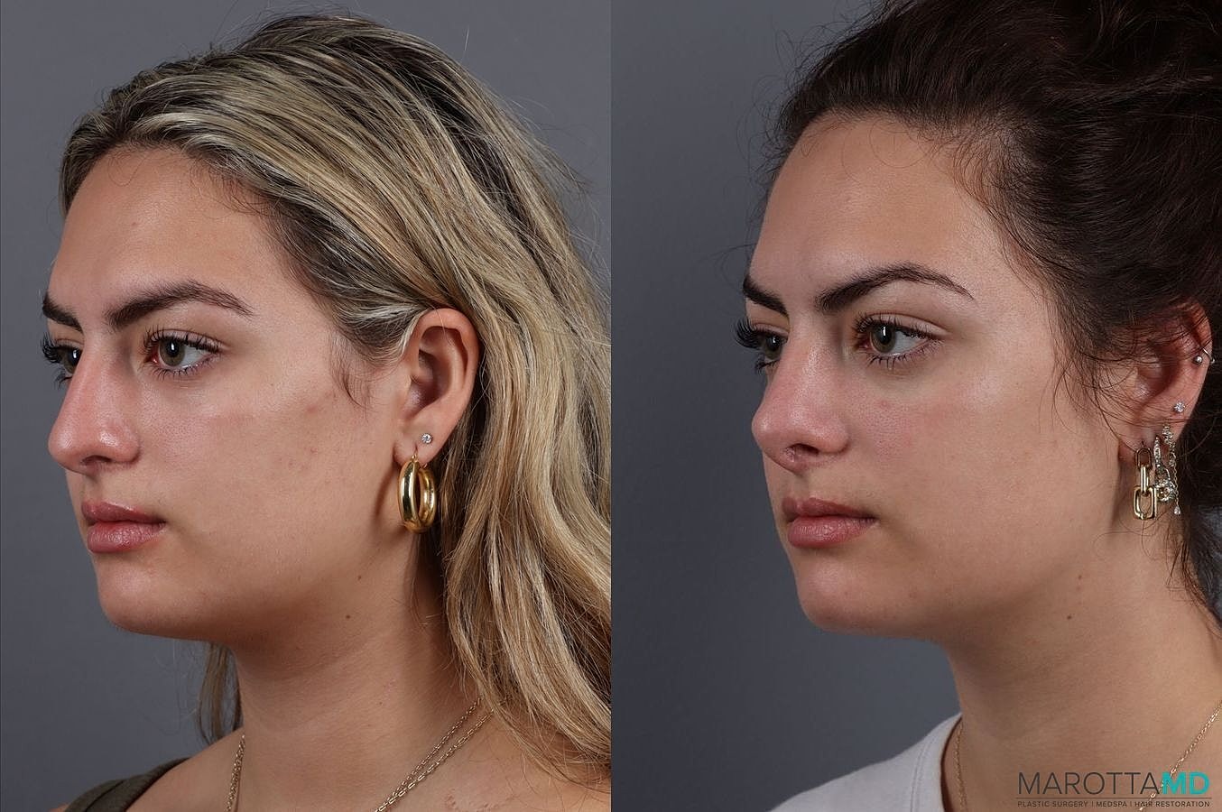 Nose Surgery Before & After
