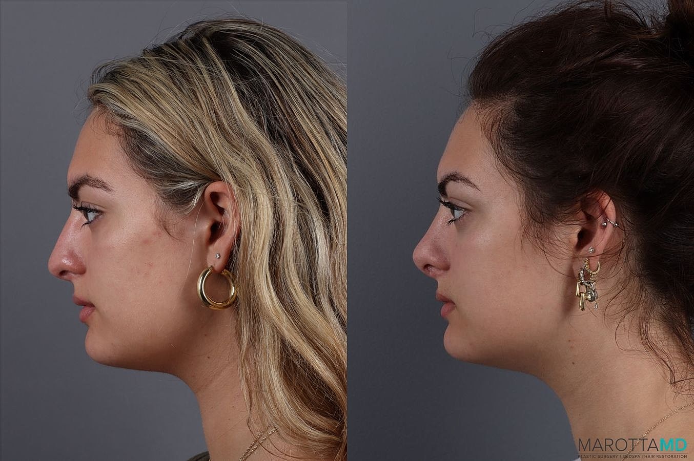 Nose Surgery Before & After