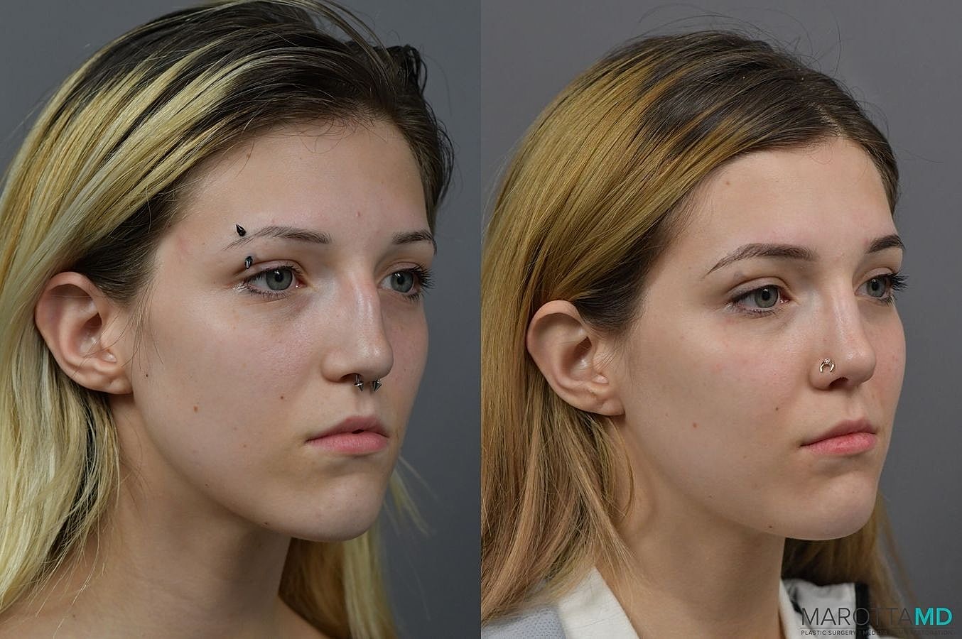 Nose Surgery Before & After