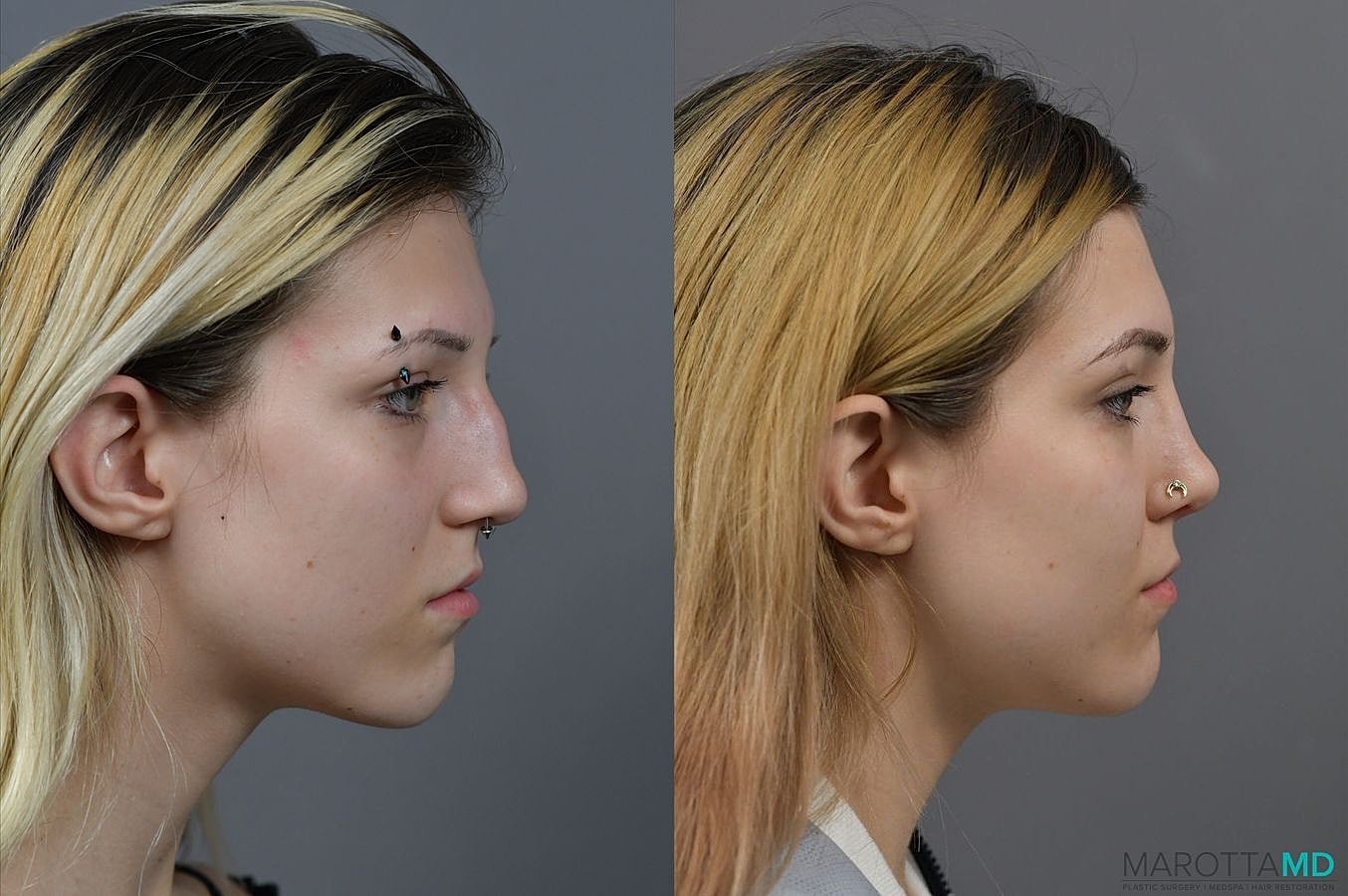 Nose Surgery Before & After