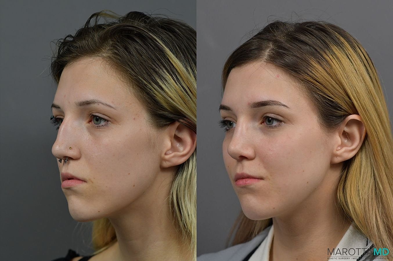Nose Surgery Before & After
