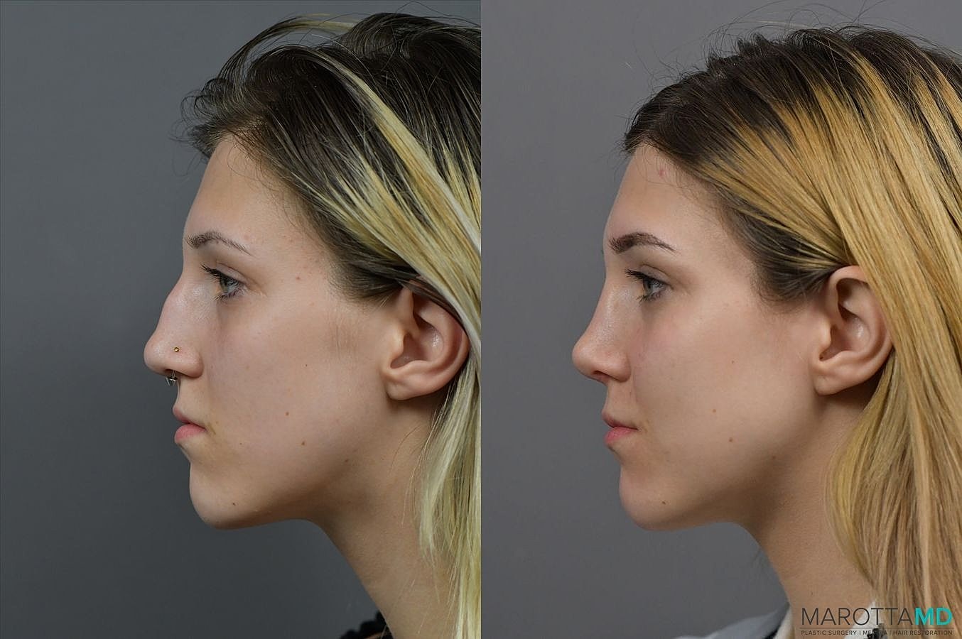 Nose Surgery Before & After