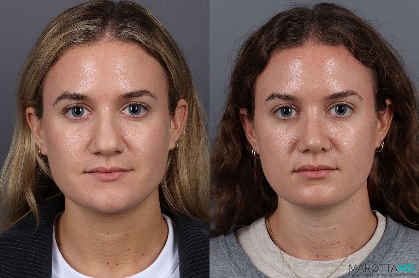 Nose Surgery Before & After