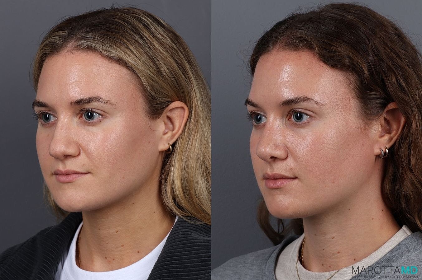 Nose Surgery Before & After