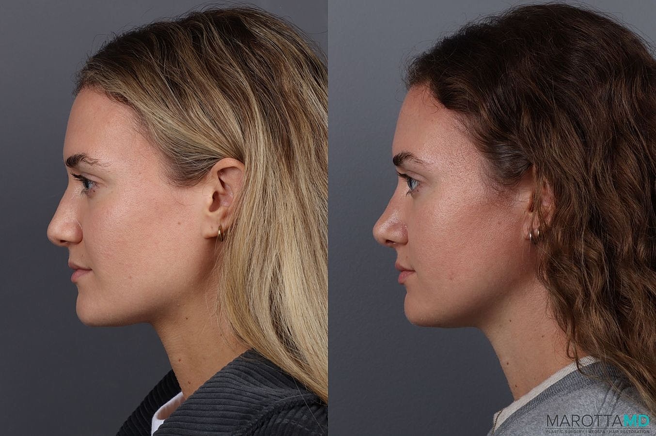 Nose Surgery Before & After