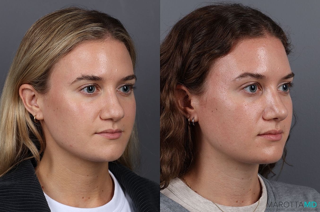 Nose Surgery Before & After