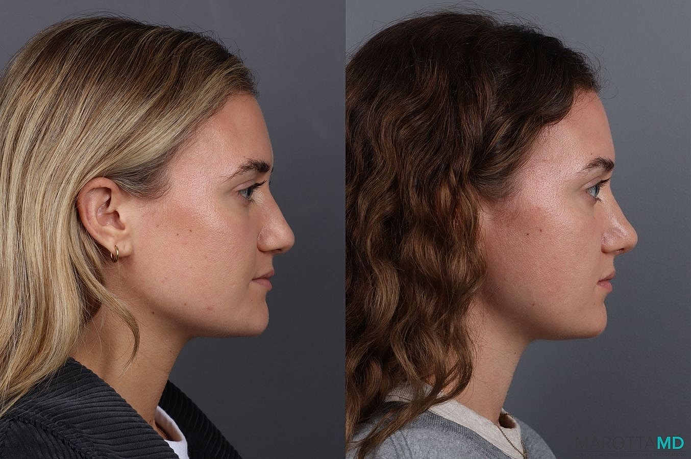 Nose Surgery Before & After