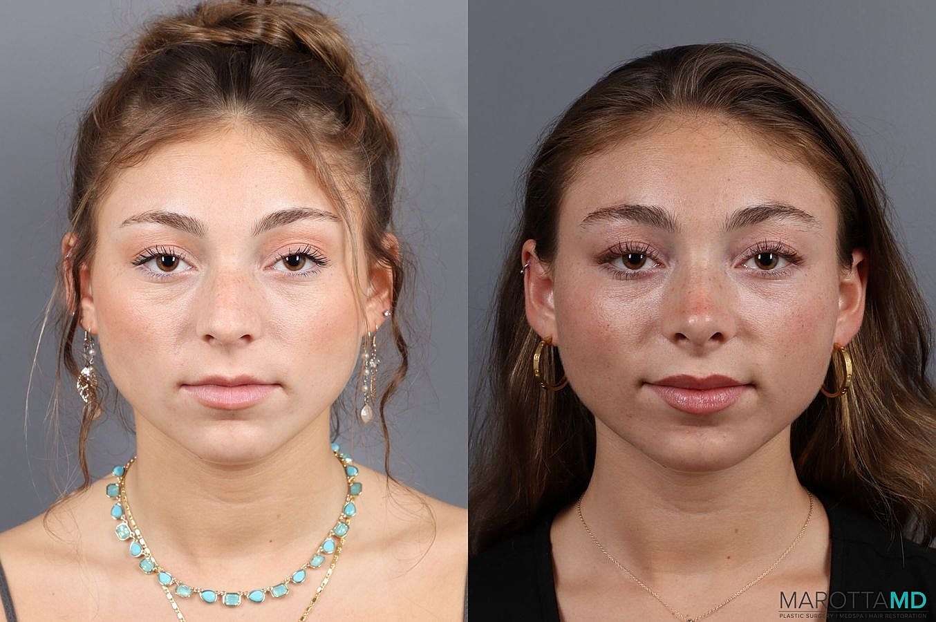 Nose Surgery Before & After