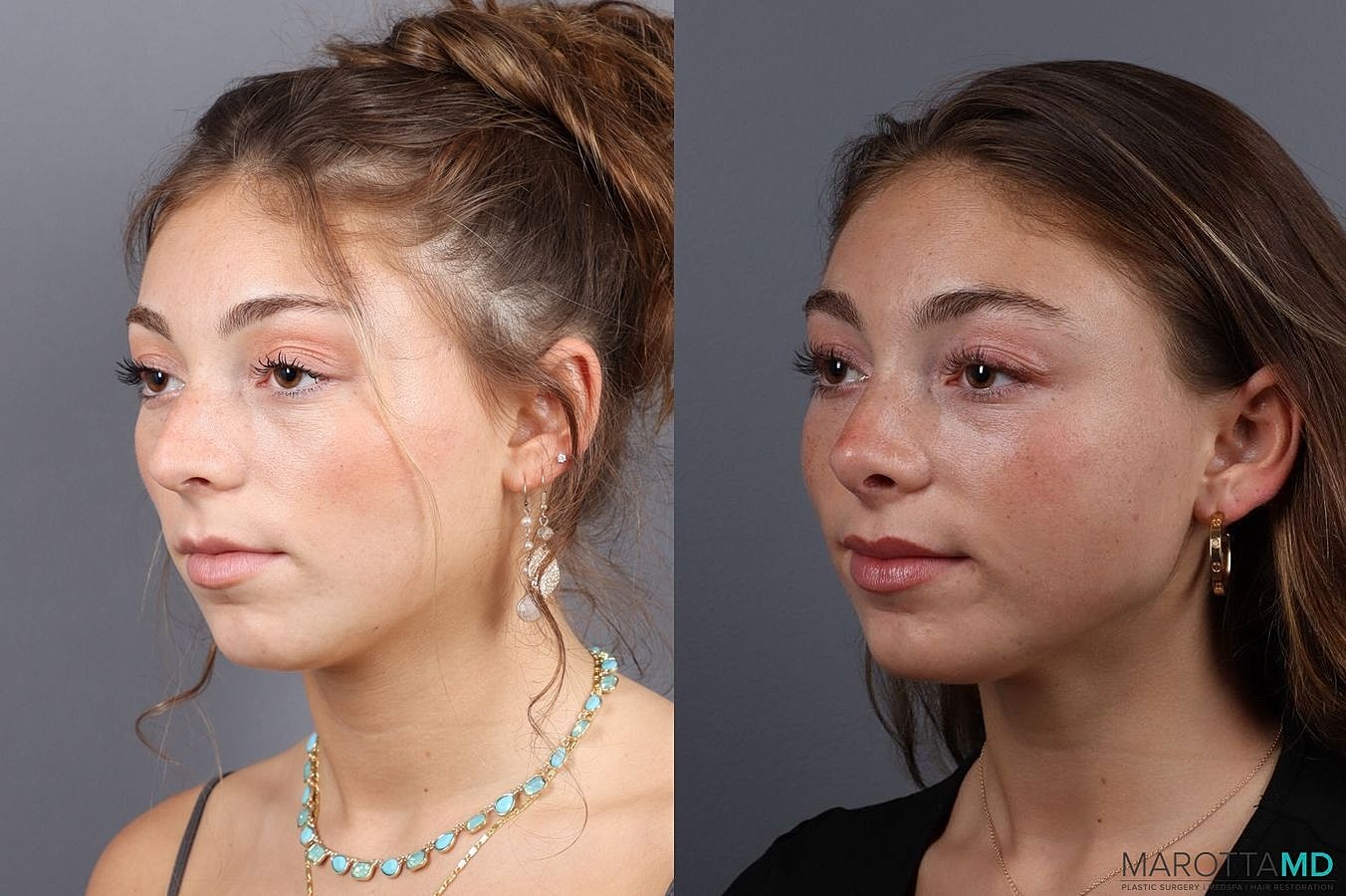 Nose Surgery Before & After