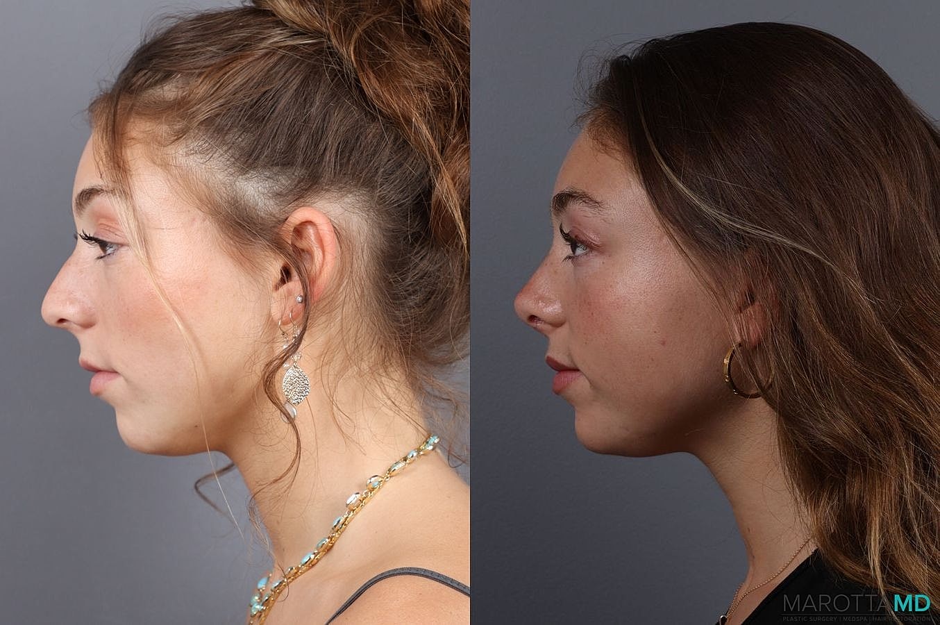 Nose Surgery Before & After