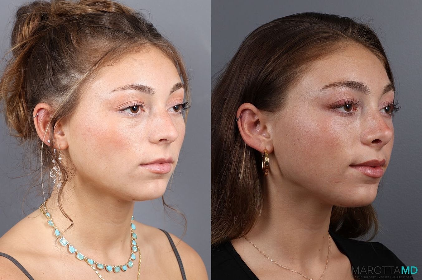 Nose Surgery Before & After