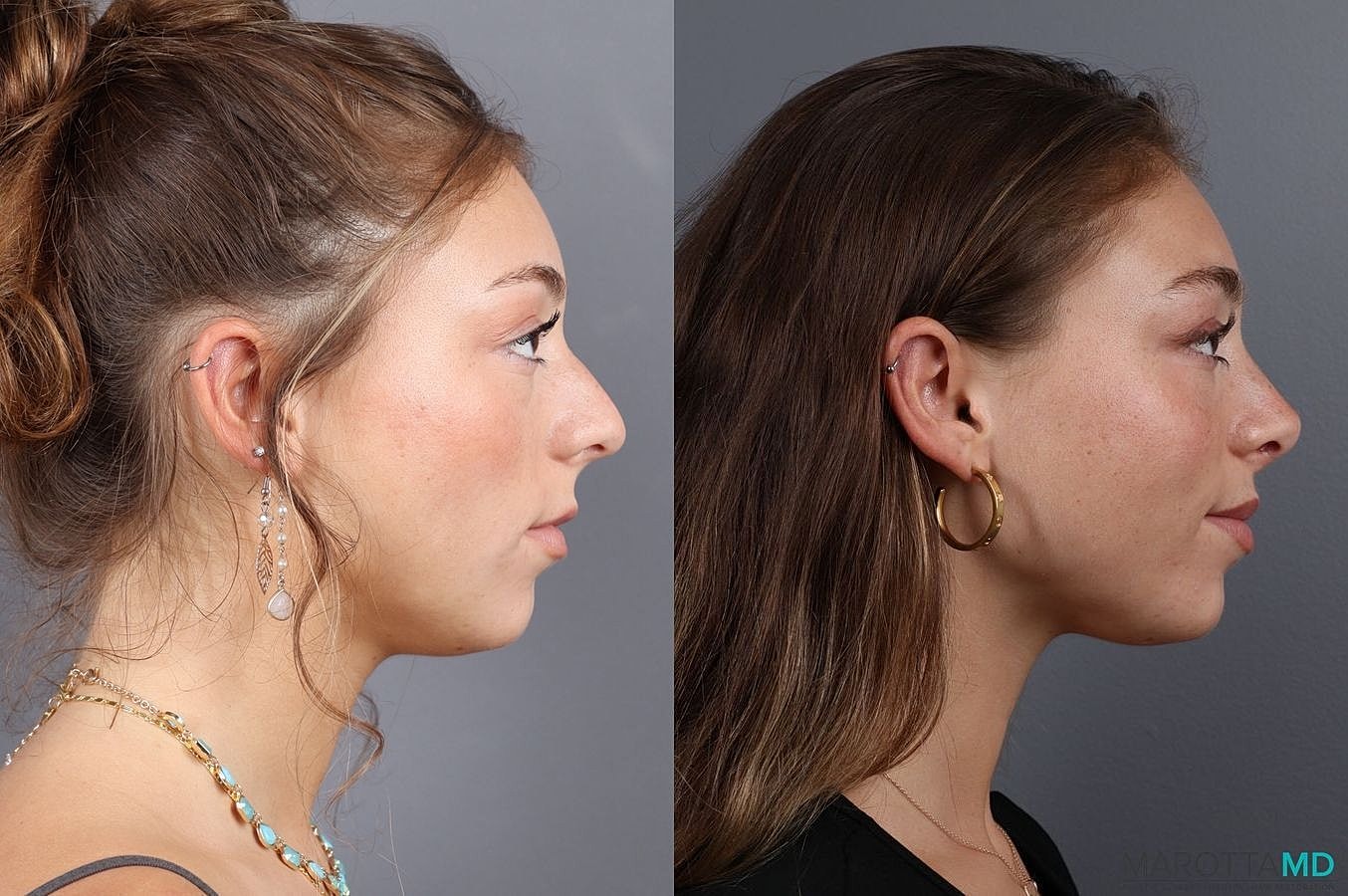 Nose Surgery Before & After