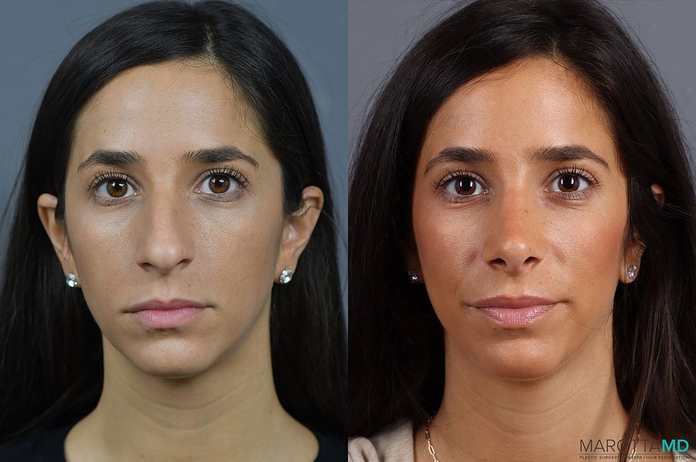 Nose Surgery Before & After