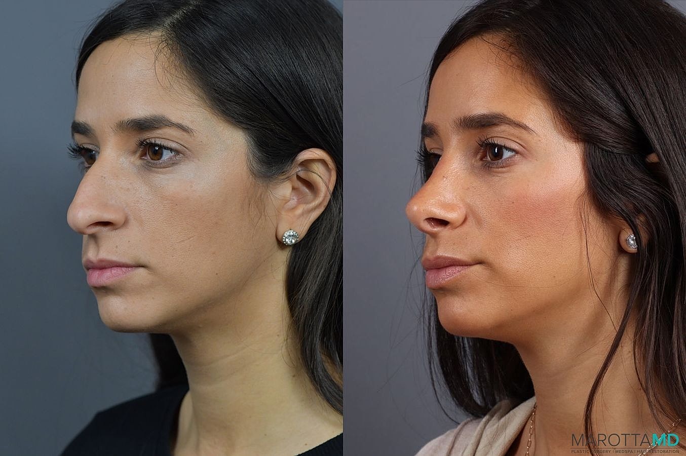 Nose Surgery Before & After