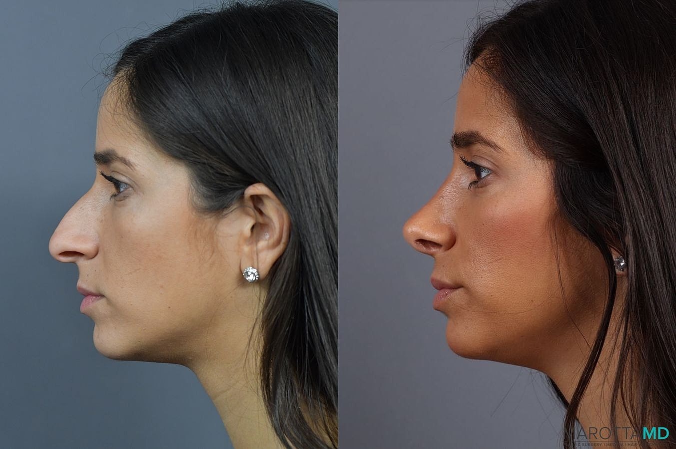 Nose Surgery Before & After