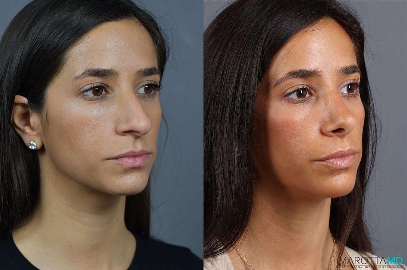 Nose Surgery Before & After