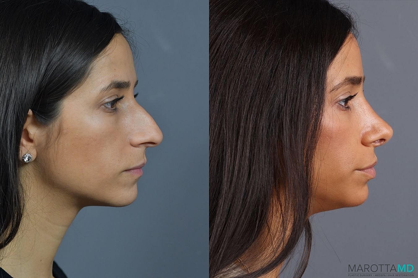 Nose Surgery Before & After