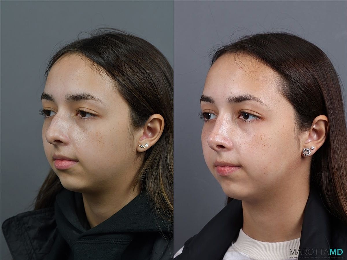 Nose Surgery Before & After
