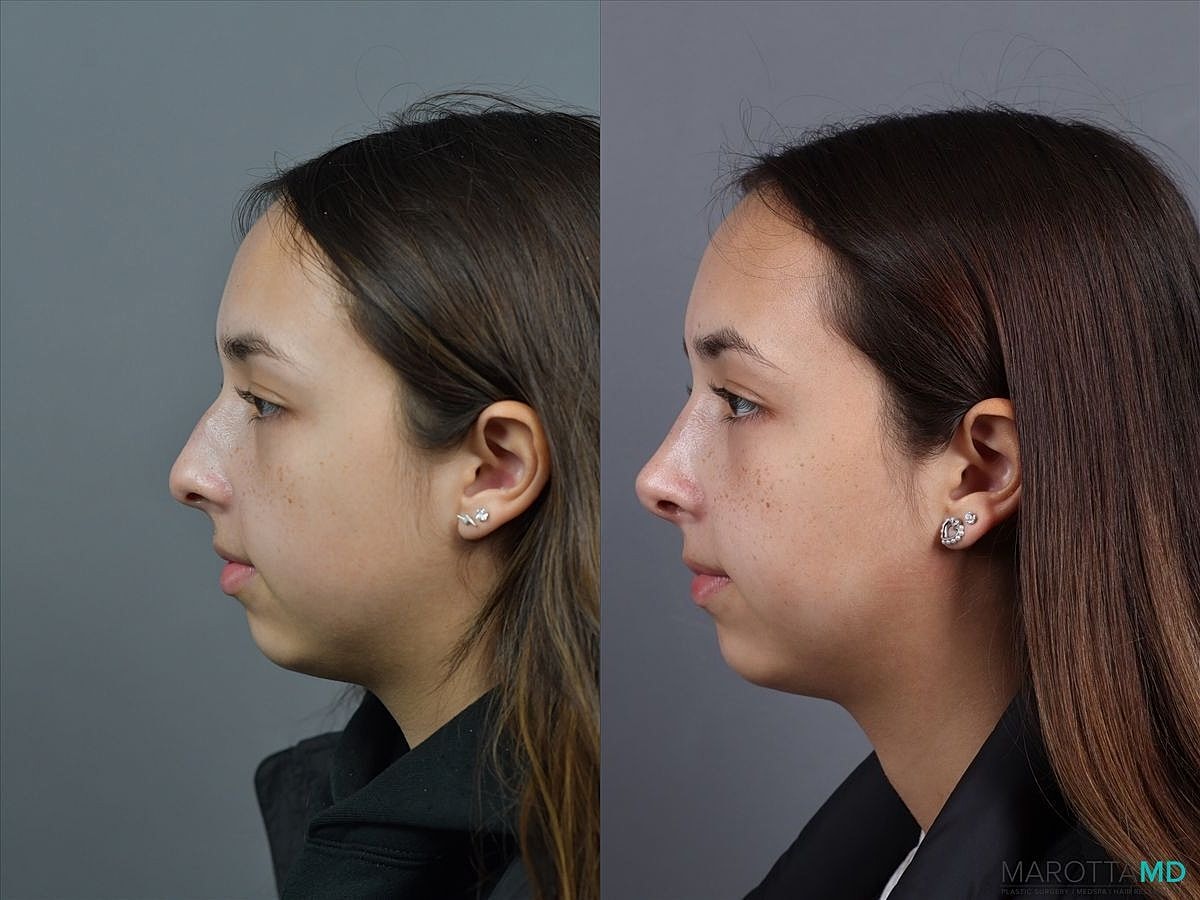 Nose Surgery Before & After