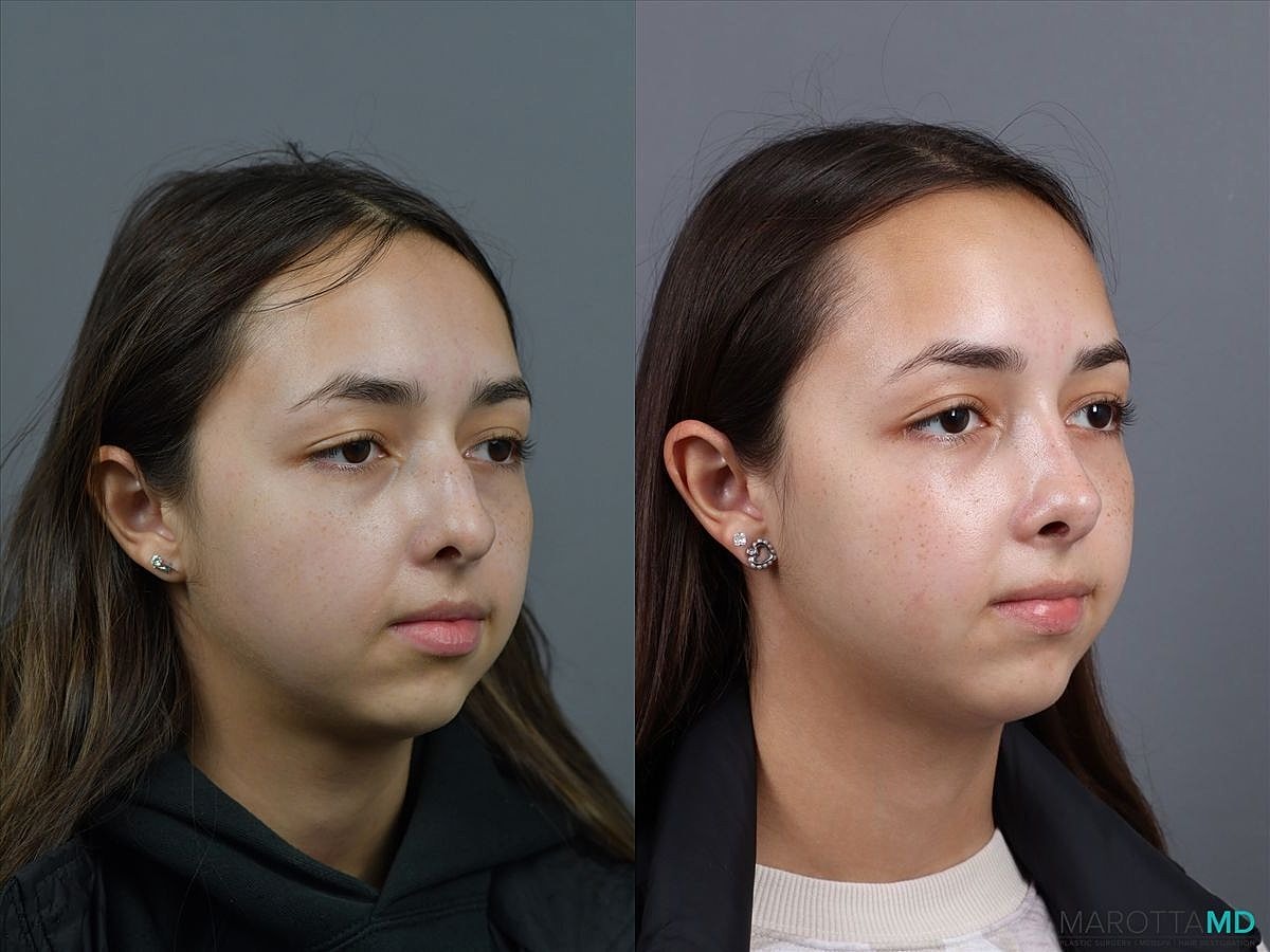 Nose Surgery Before & After