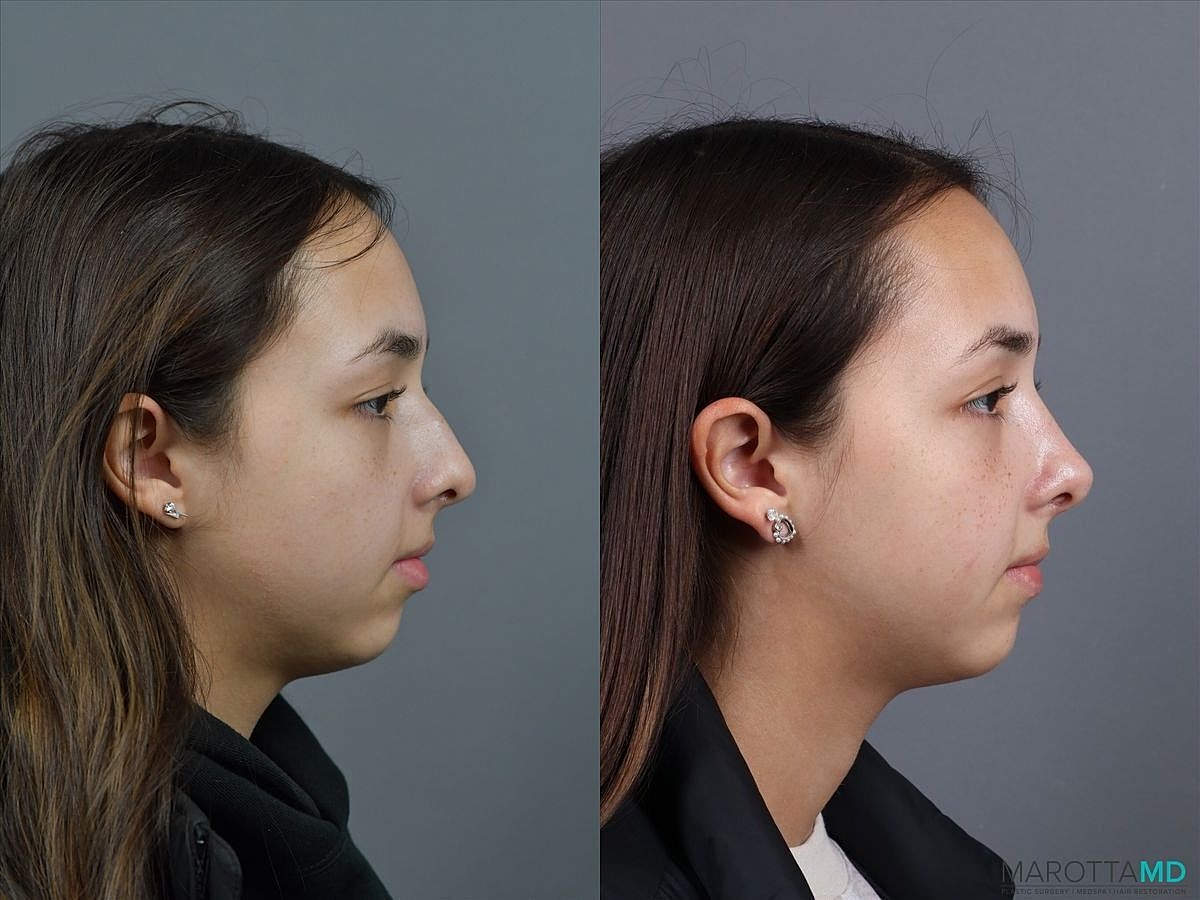 Nose Surgery Before & After