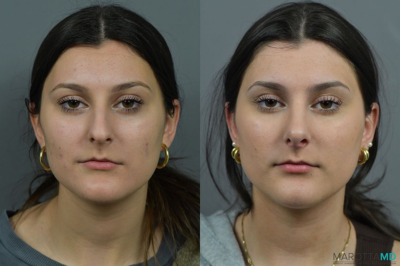 Nose Surgery Before & After