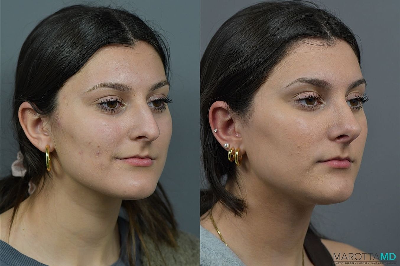 Nose Surgery Before & After