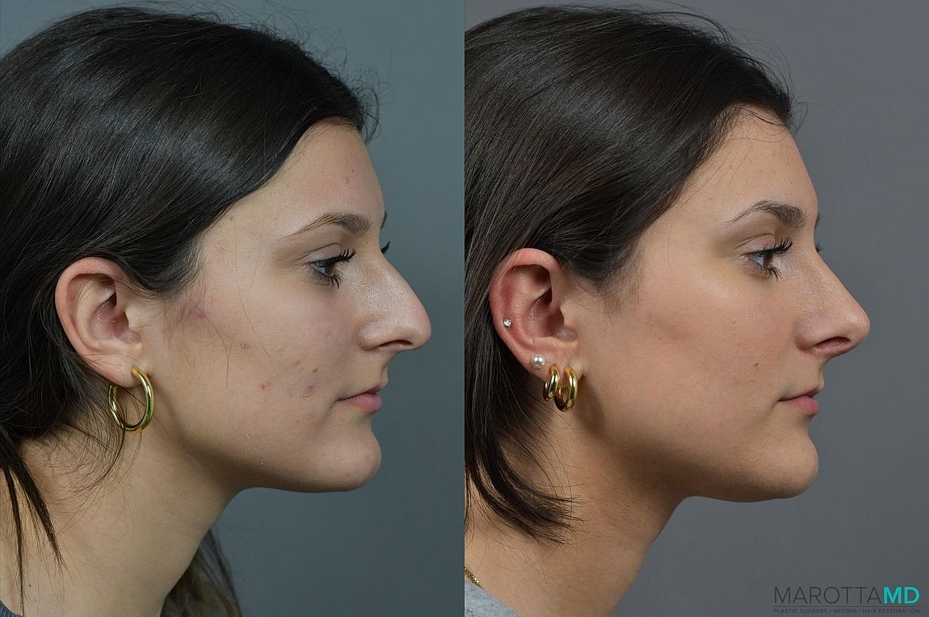 Nose Surgery Before & After