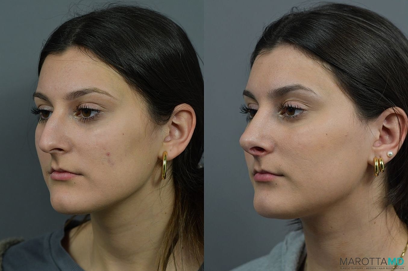 Nose Surgery Before & After