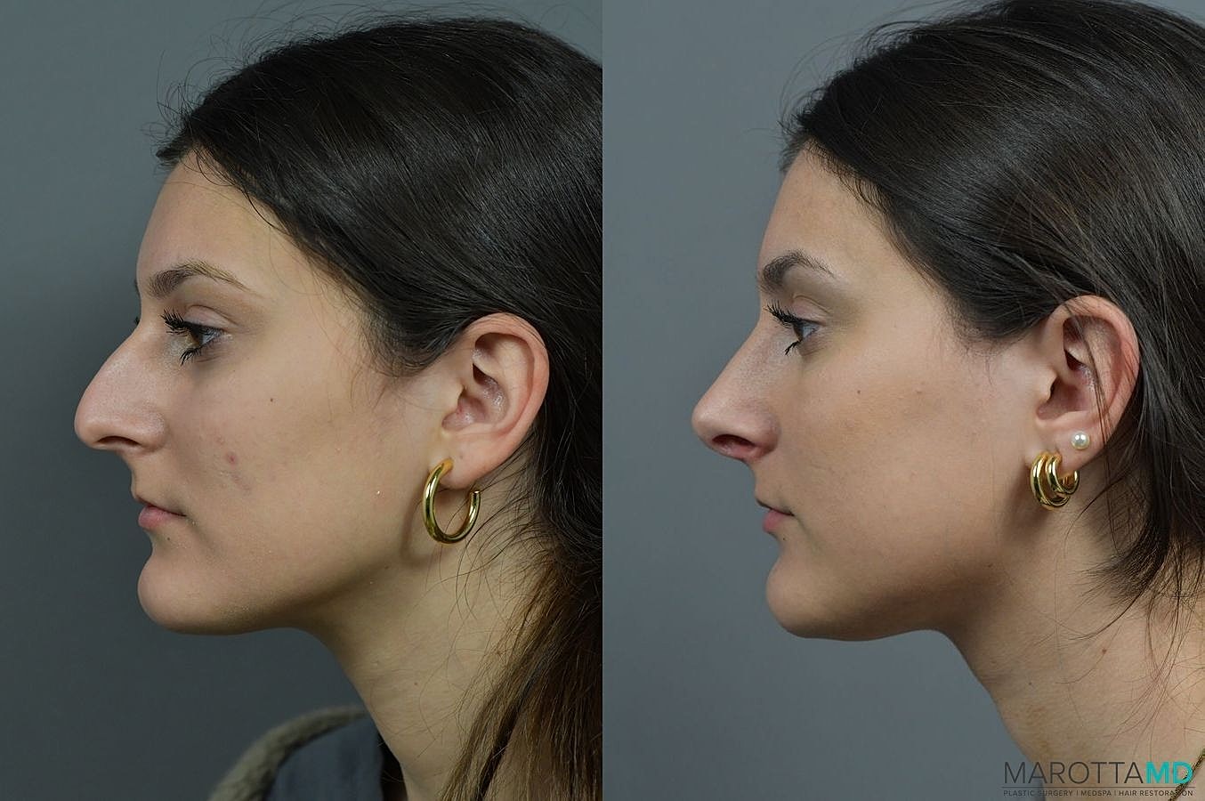 Nose Surgery Before & After