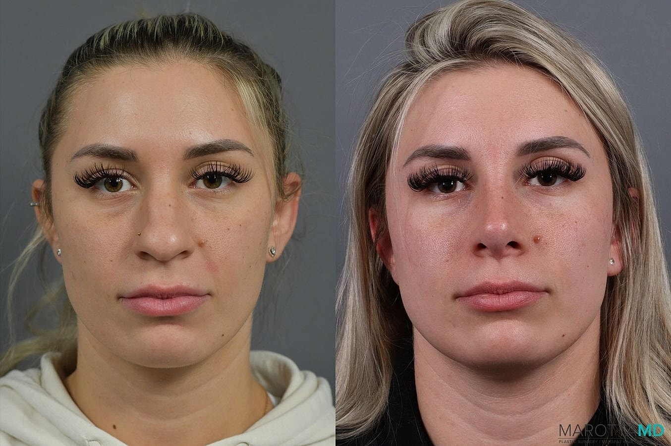 Nose Surgery Before & After