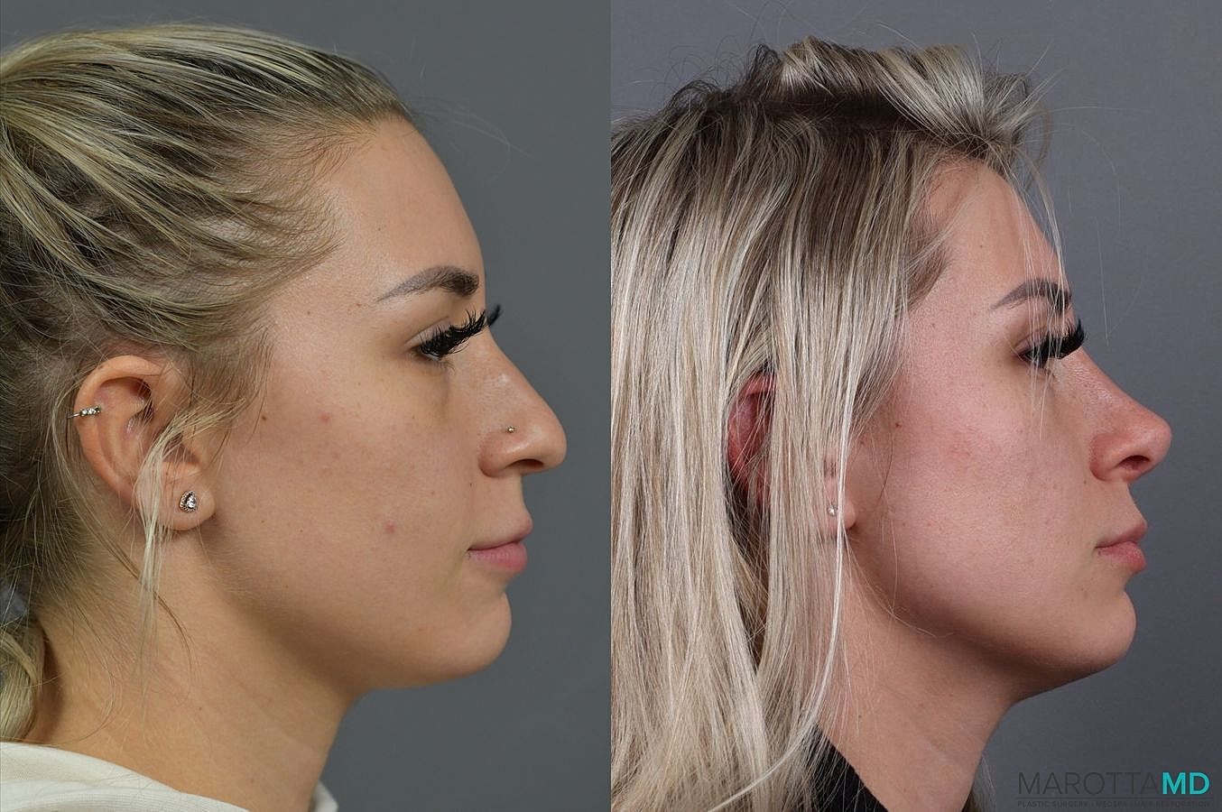 Nose Surgery Before & After