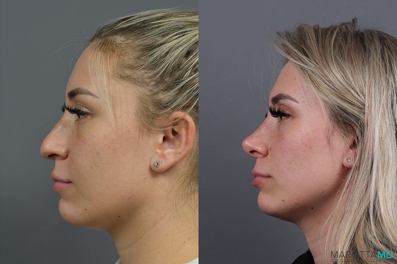 Nose Surgery Before & After