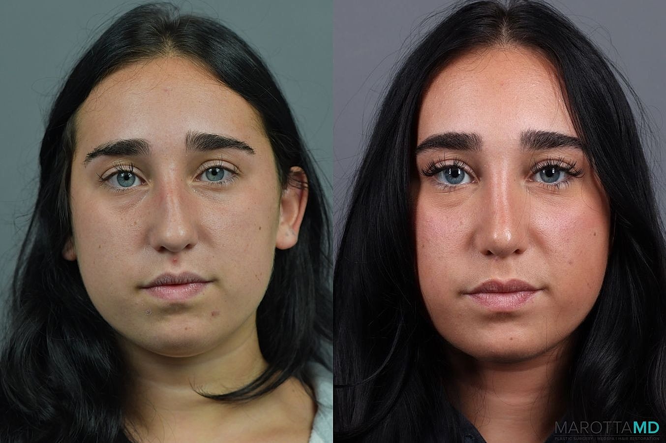 Nose Surgery Before & After